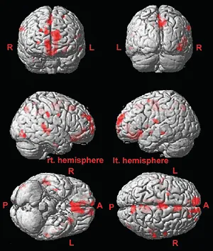 brain abnormalities